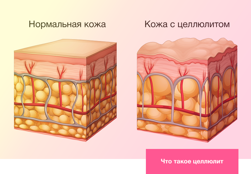 Что такое целлюлит