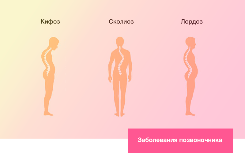 Психосоматика отделов позвоночника. Психосоматика искривление позвоночника. Сколиоз позвоночника психосоматика. Осанка психосоматика. Искривление позвоночника психосоматика у детей.